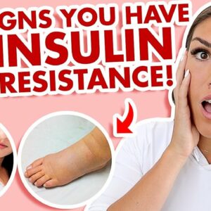 Insulin Resistance Symptoms (CAN'T Lose Weight? THIS Is WHY!) 2021