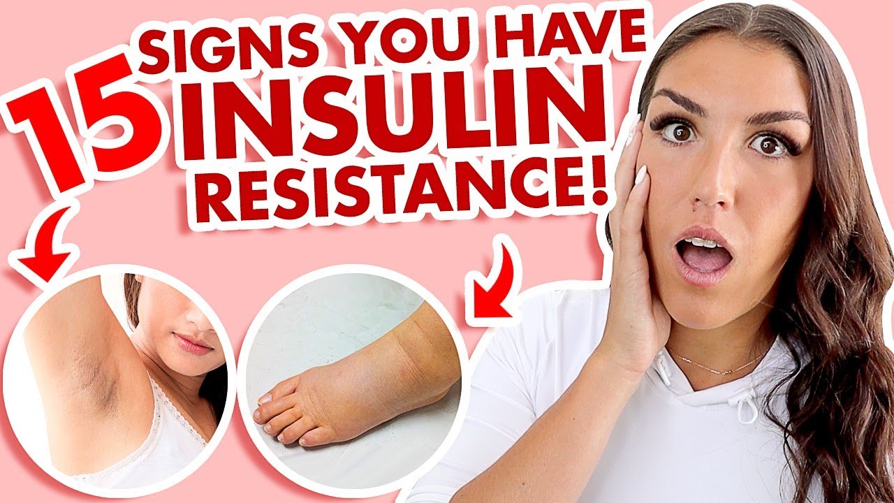 Insulin Resistance Symptoms (CAN'T Lose Weight? THIS Is WHY!) 2021